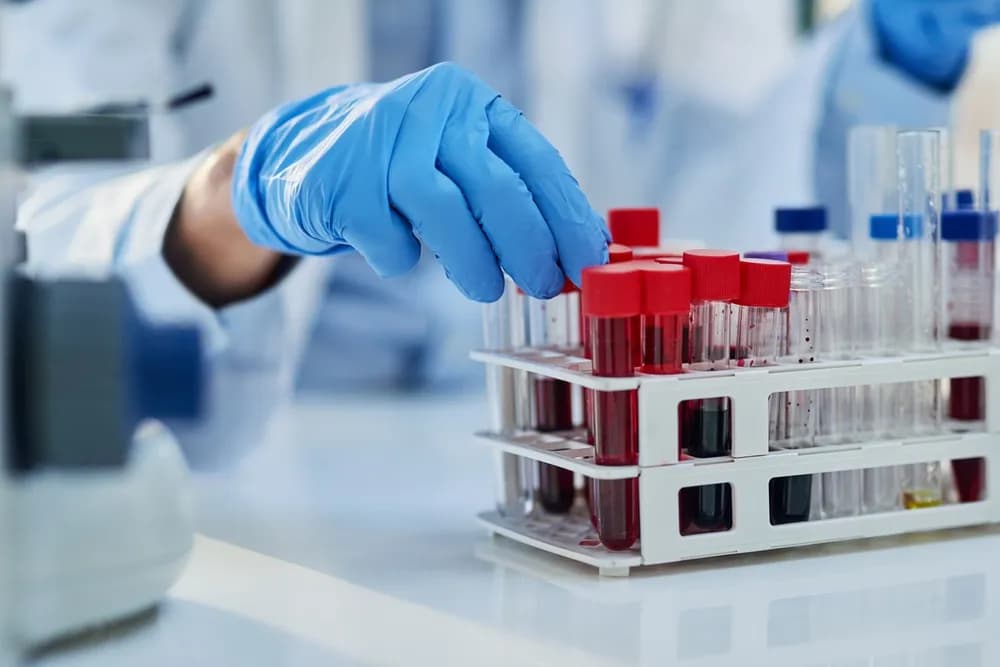 Studija: Krvni test otkriva znakove Alchajmerove bolesti "decenijama pre simptoma"