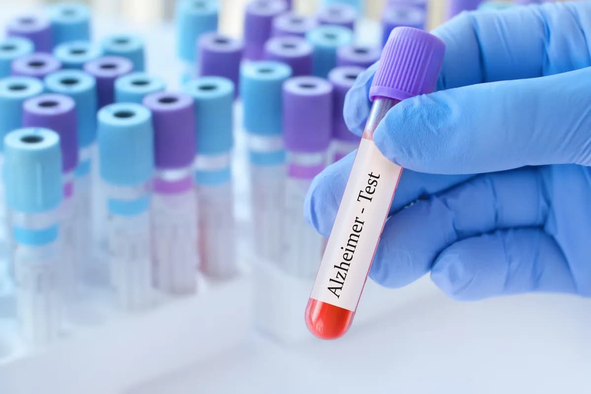 Novi test iz krvi mogao bi da predvidi rizik od Alchajmerove bolesti