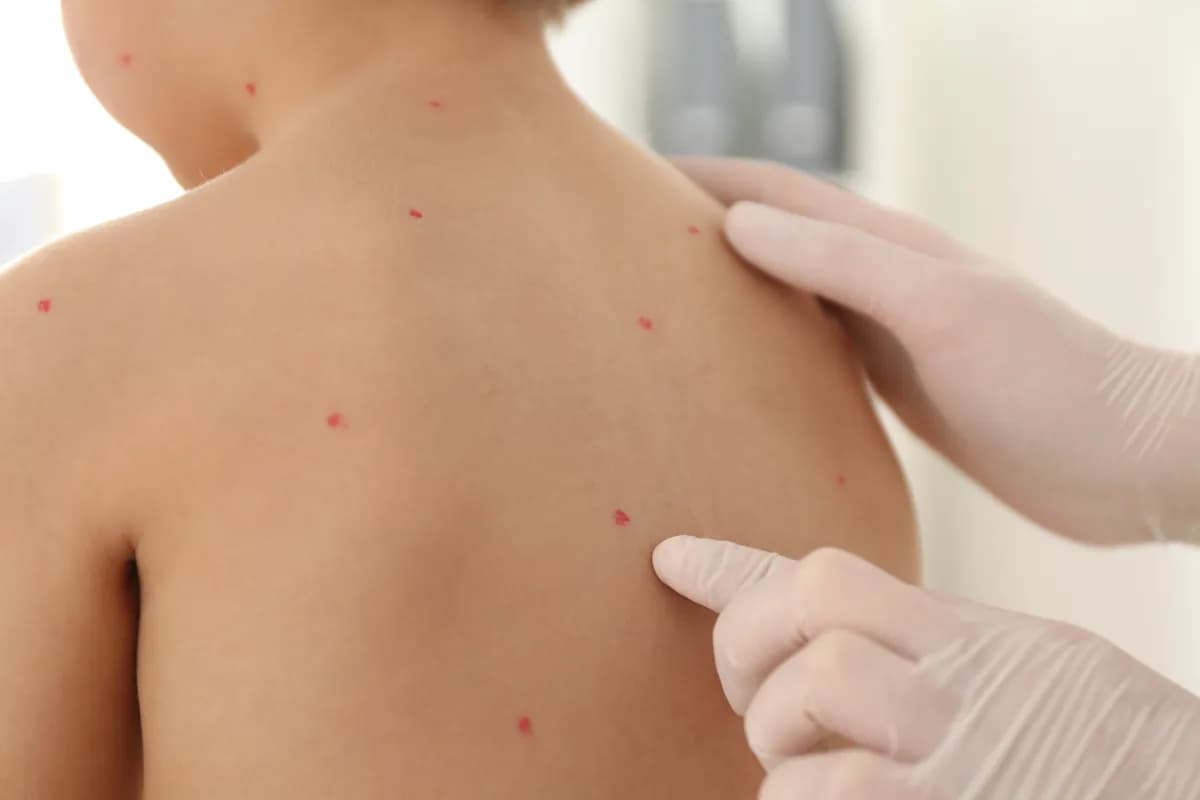 Ovčje boginje kod dece - kakvi su simptomi i na koji način se leče