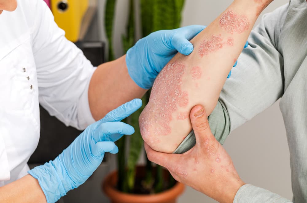 Sunce i muke s psorijazom: Spas u biološkoj terapiji