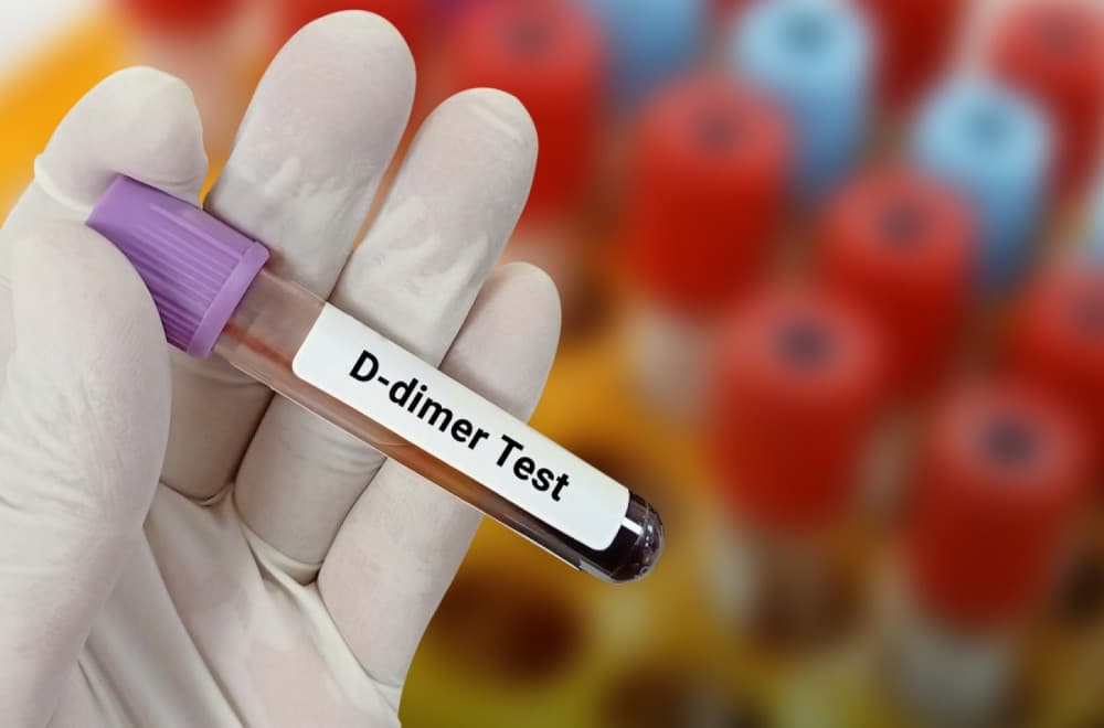 D-dimer test: Šta znači povišen nalaz i kada je vreme za brigu?