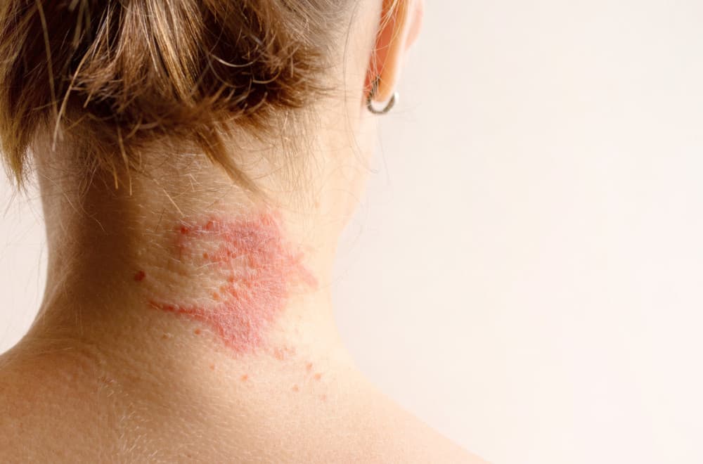 Kad svaki dodir peče: Dermatolog savetuje kako se boriti sa atopijskim dermatitisom VIDEO
