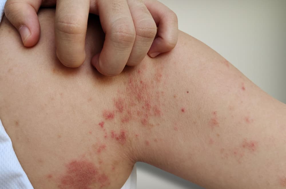 Impetigo se širi po Jadranu; Lekari upozoravaju: "Pridržavajte se ovih pravila"