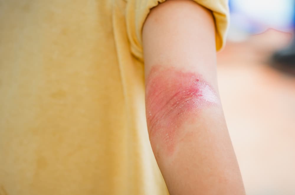 "Nije svako crvenilo atopijski dermatitis"; Doktorka otkrila najčešću grešku u lečenju